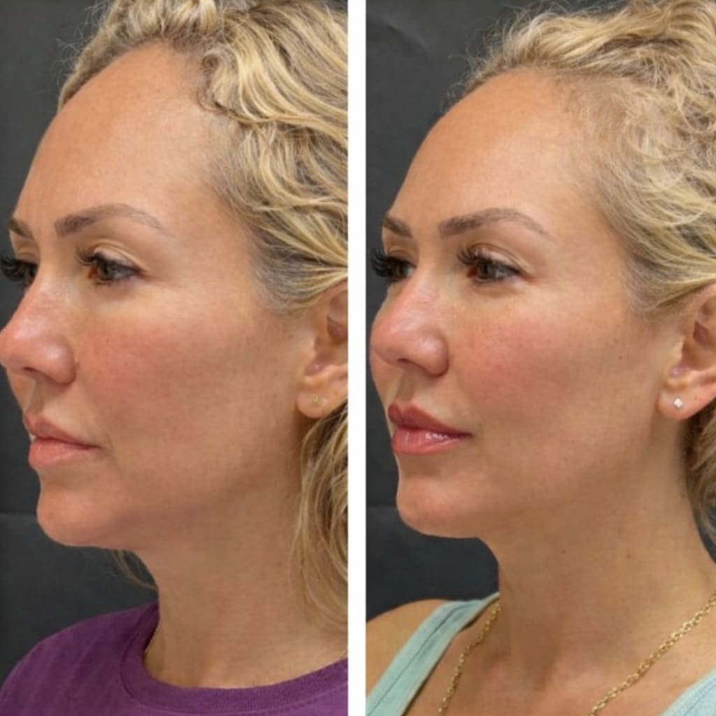 Eyelida Lymphatic Face Brush