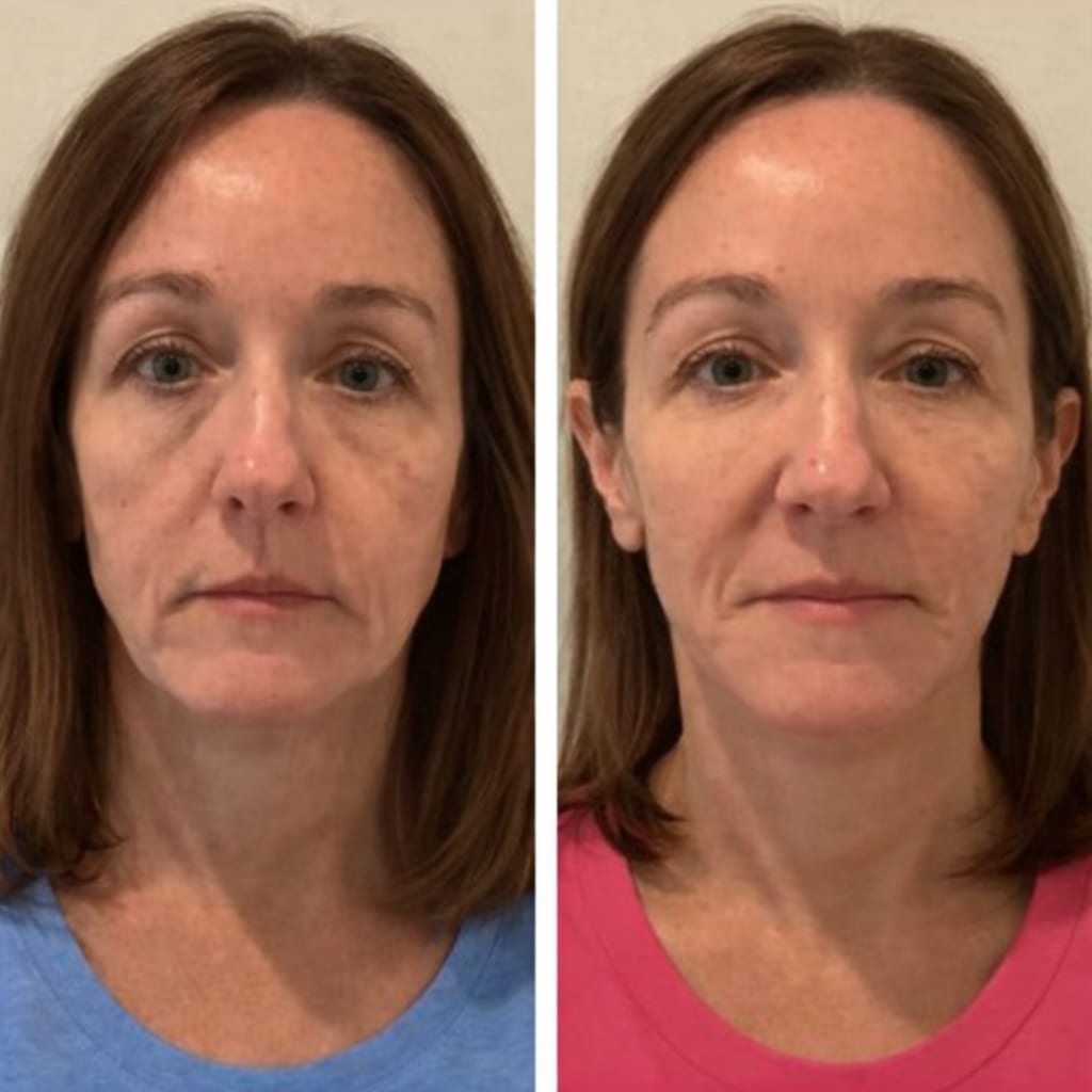 Eyelida Lymphatic Face Brush