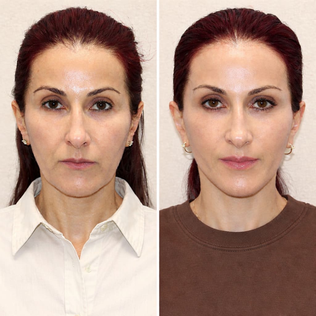 Eyelida Lymphatic Face Brush